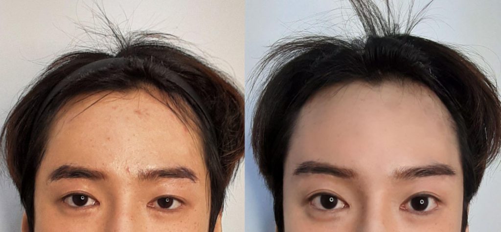 ผลงานและรีวิวของ ONLIF Plastic Surgery 03