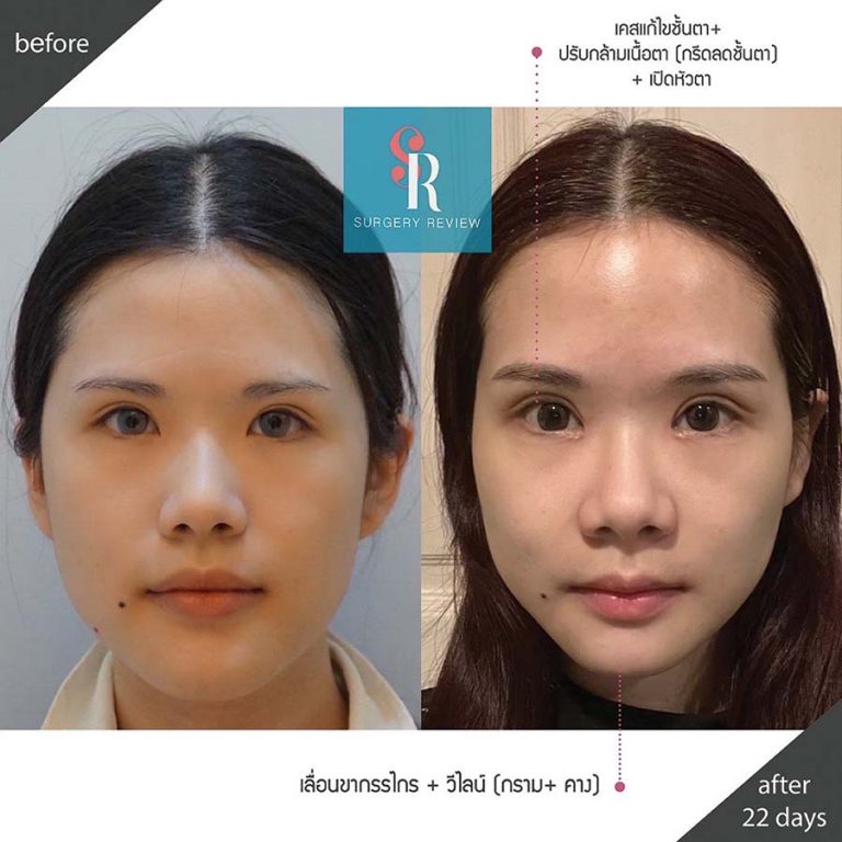รีวิวผ่าตัดศัลยกรรมเลื่อนขากรรไกรและผ่าตัดชั้นตาให้หวานละมุนที่เกาหลี