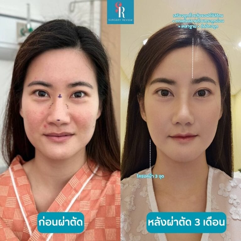 รีวิวศัลยกรรมเกาหลี โครงหน้า 3 จุด (โหนกแก้ม กราม คาง) จมูก และเสริมร่องแก้มด้วยซิลิโคน