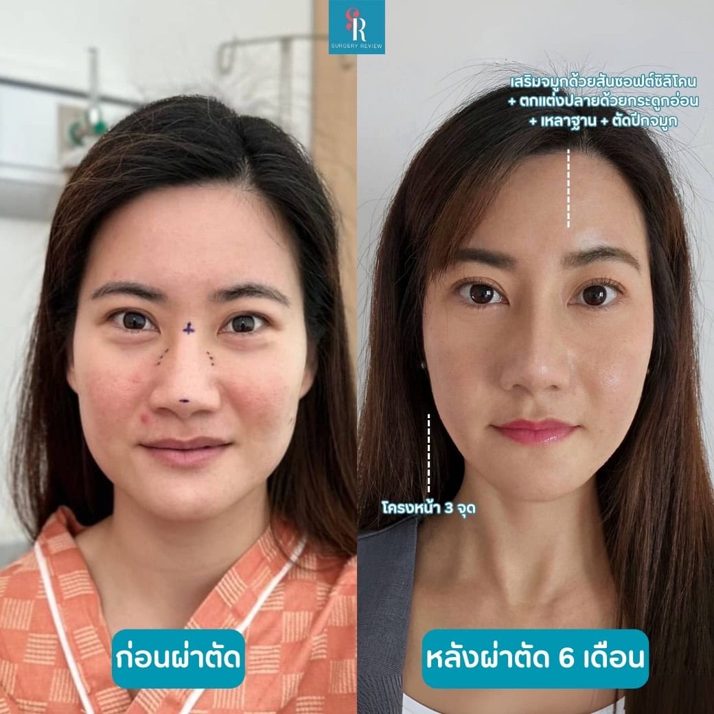 รีวิว ก่อน หลัง ศัลยกรรมโครงหน้า 3 จัด เสริมจมูก ที่เกาหลี