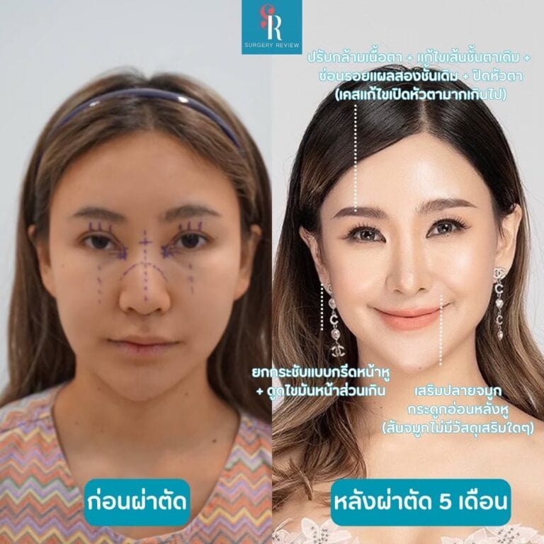 รีวิวศัลยกรรมเกาหลี กรีดชั้นตา ยกกระชับหน้าร่วมกับดูดไขมันหน้า