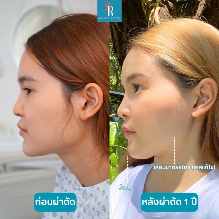 รีวิวศัลยกรรมเกาหลี ผ่าตัดเลื่อนขากรรไกรเคสแก้ไข วีไลน์(กราม+คาง)