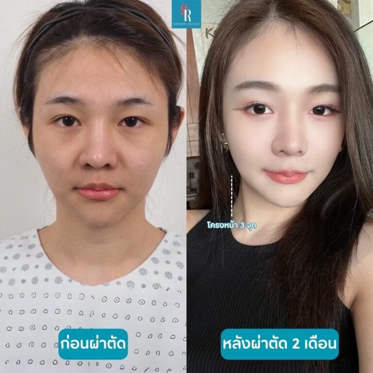 รีวิวศัลยกรรมโครงหน้า 3จุดเกาหลี ที่โรงพยาบาล EU