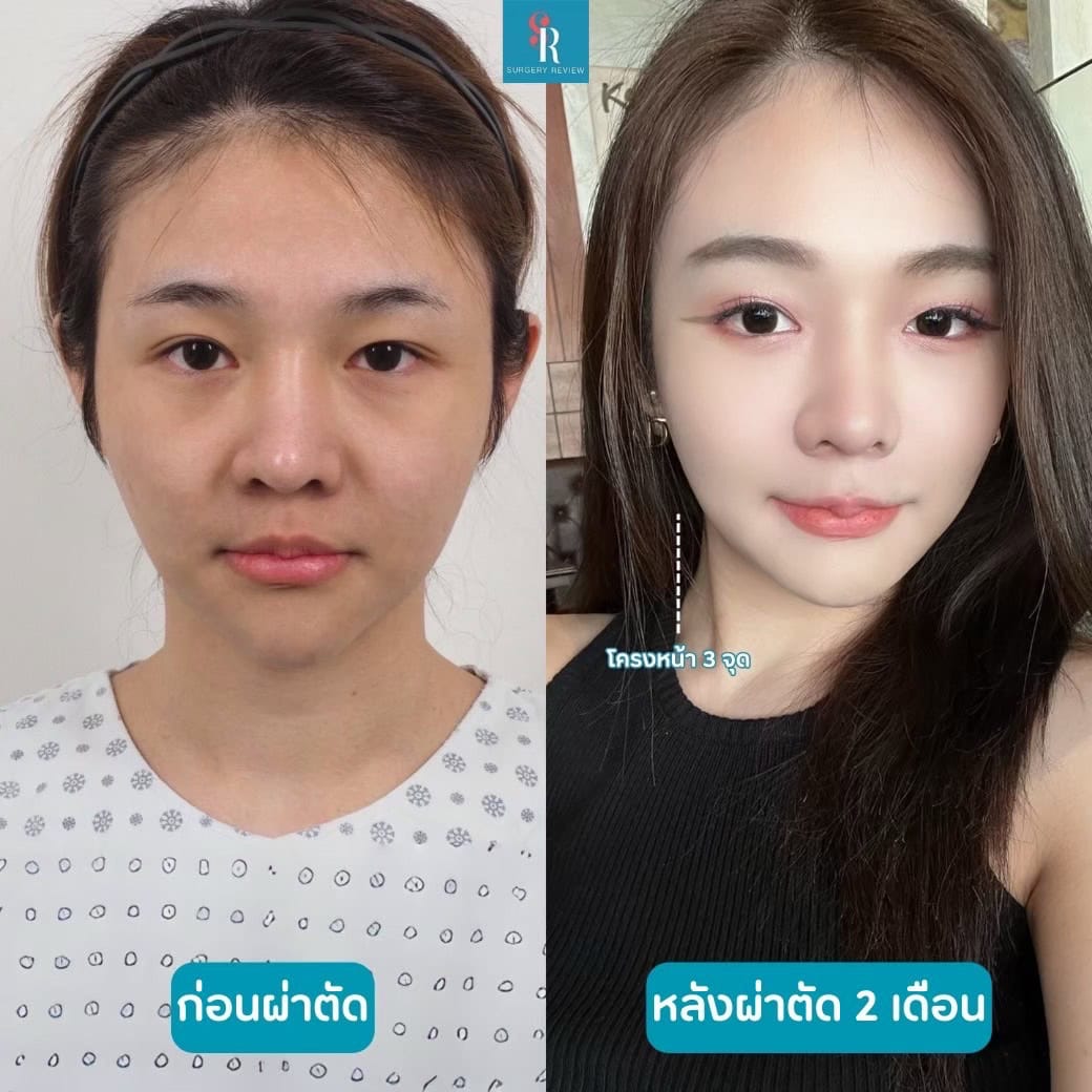 รีวิวศัลยกรรมโครงหน้า 3จุดเกาหลี ที่โรงพยาบาล EU