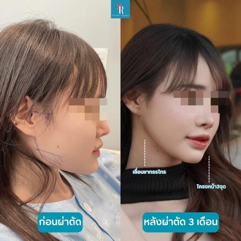 รีวิวศัลยกรรมเกาหลี ผ่าตัดขากรรไกร eu