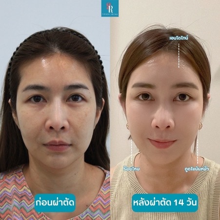 Salinthip รีวิว เอนโดไทน์ ทีเ่กาหลี ก่อน-หลังผ่าตัด