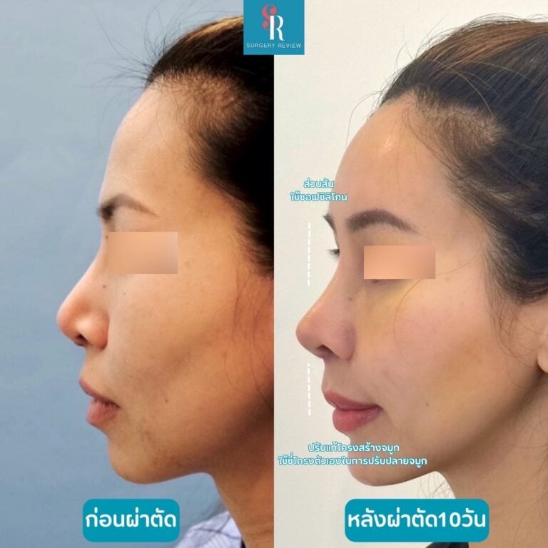 รูปรีวิวศัลยกรรมหลังแก้จมูกที่ hanabi