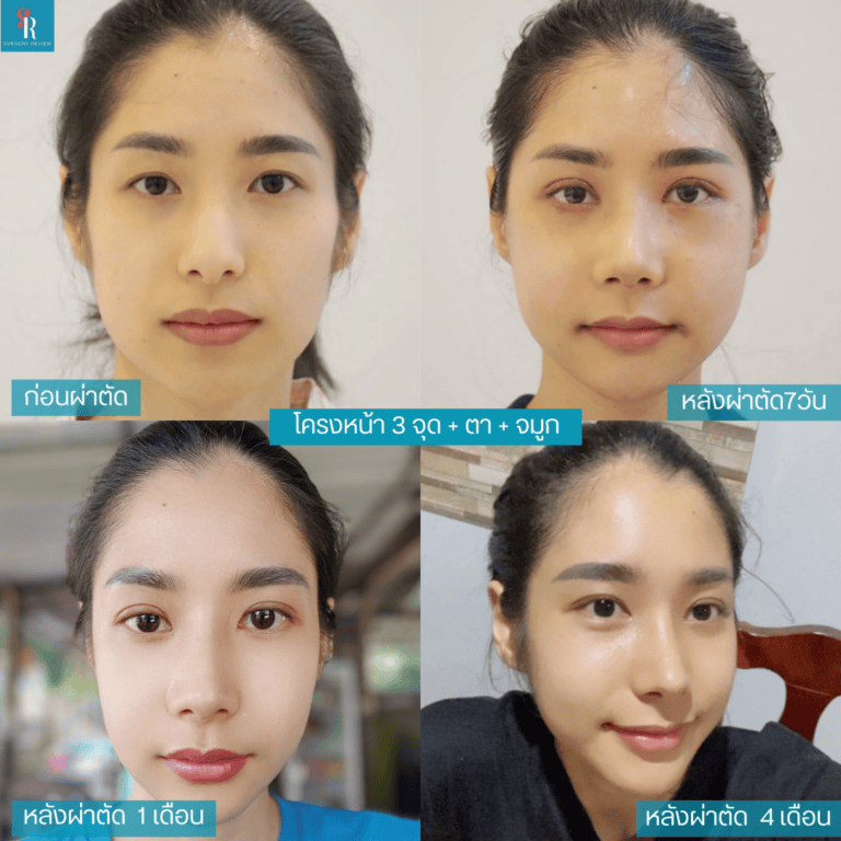 รีวิวศัลยกรรม ปรับโครงหน้า 3 จุด ตา และจมูก แก้ใบหน้าดูดุเหมือนผู้ชาย