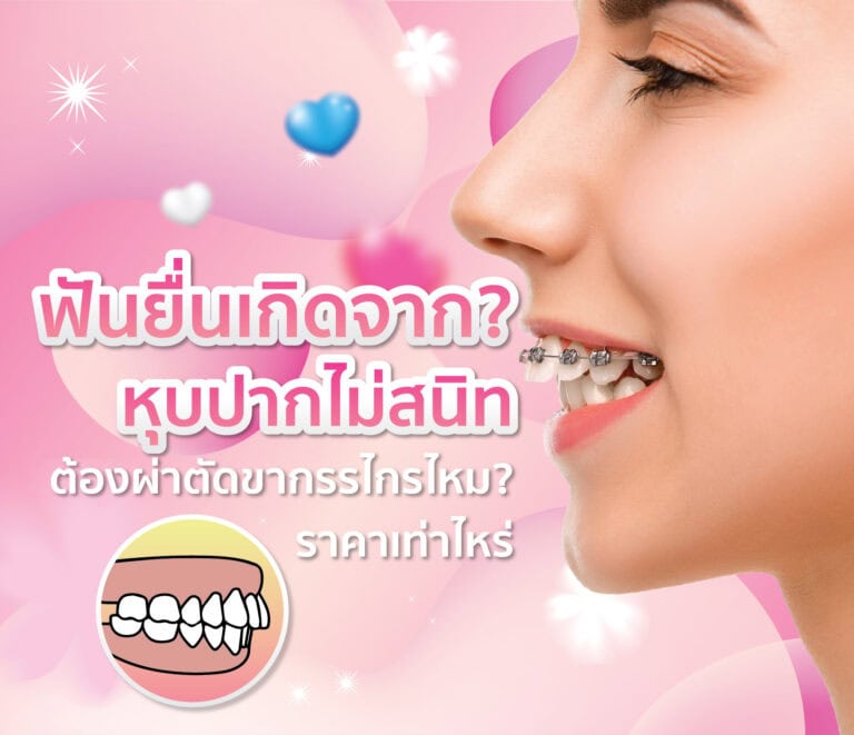 ฟันยื่นเ