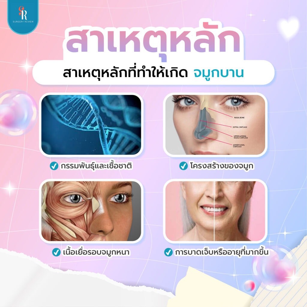 จมูกบาน สาเหตเกิดจาก