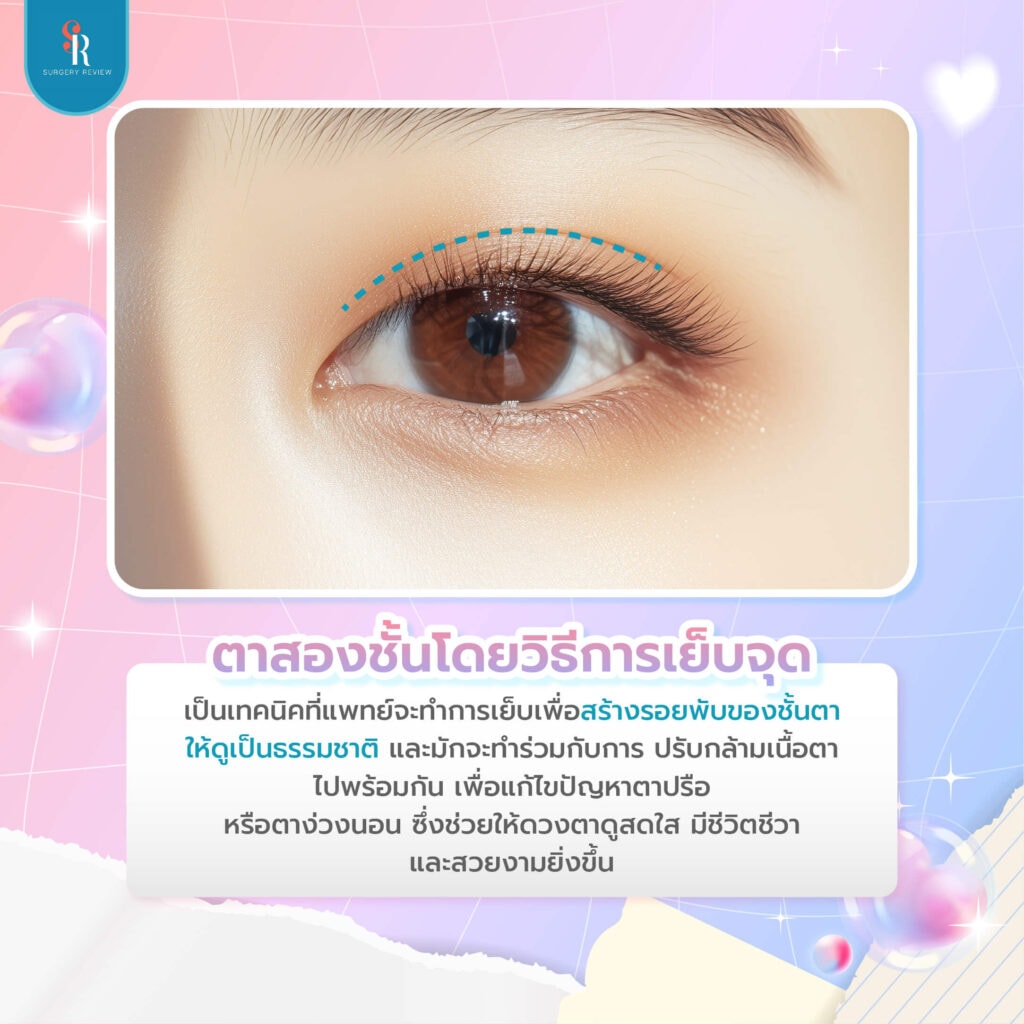 ทำตาสองชั้นแบบเย็บจุด