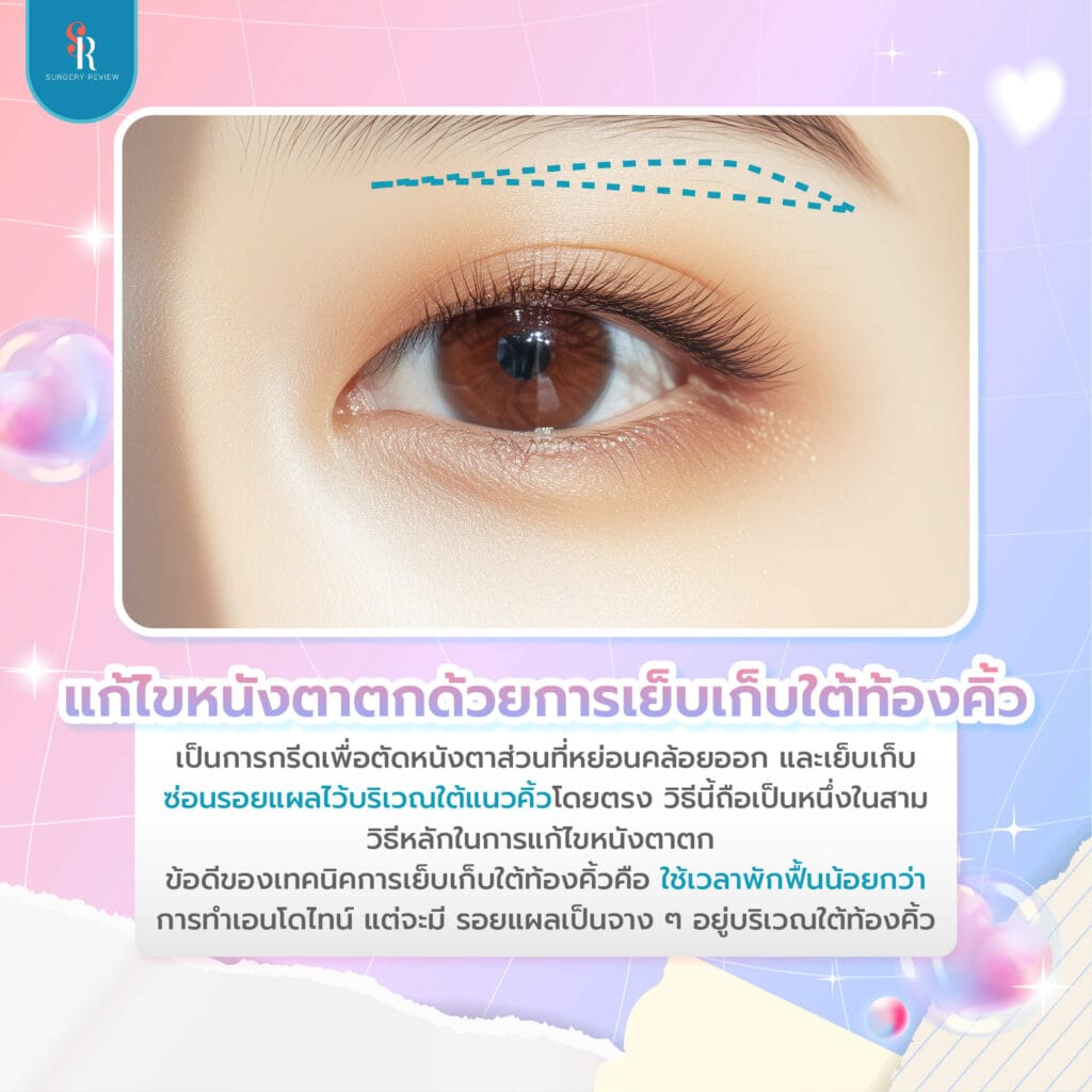 แก้ไขหนังตาตก เย็บเก็บใต้ท้องคิ้ว